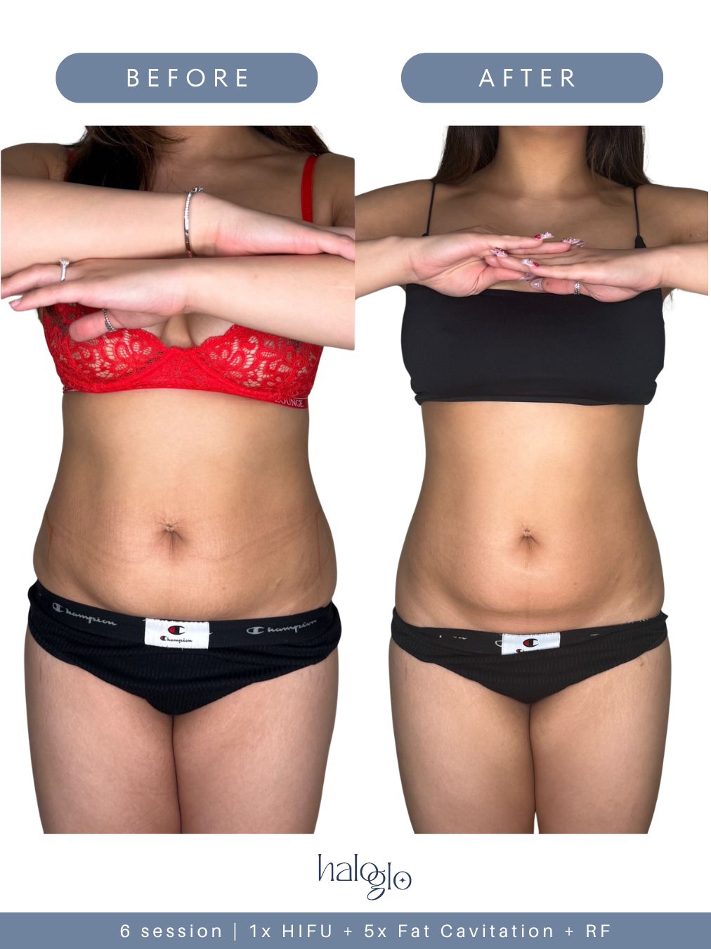 Before and after — 6 sessions — HIFU + Fat Cavitation + RF