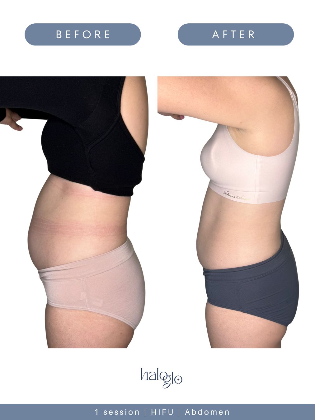 Before and after — 1 session — HIFU — Abdomen