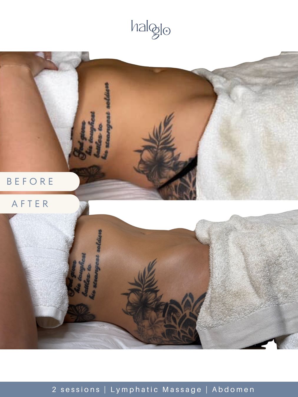 Before and after — 2 sessions — Lymphatic Massage — Abdomen
