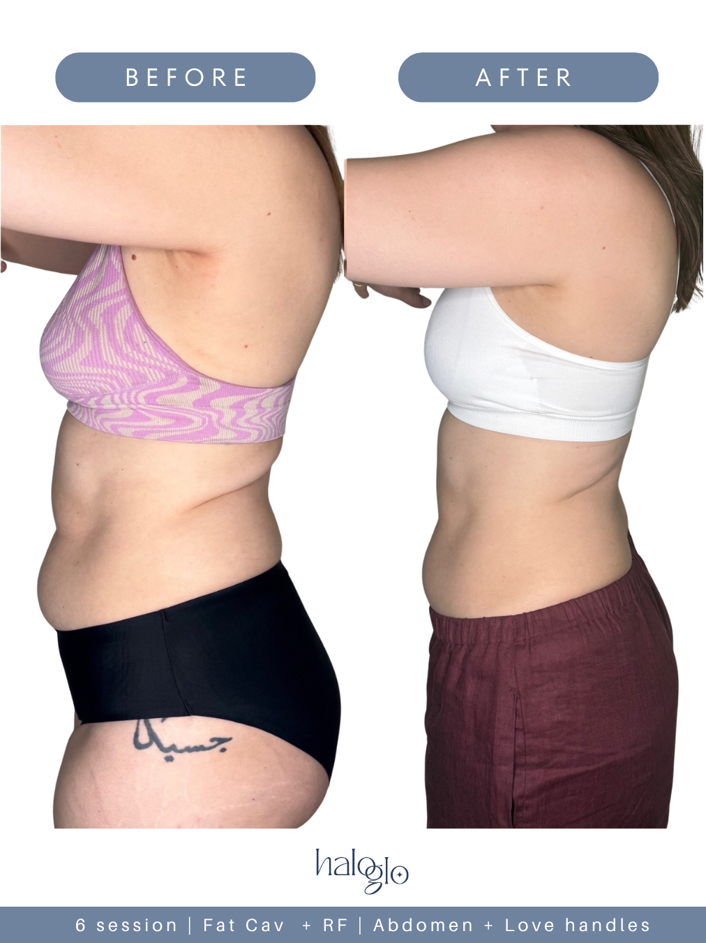 MELIS · HIFU — before and after